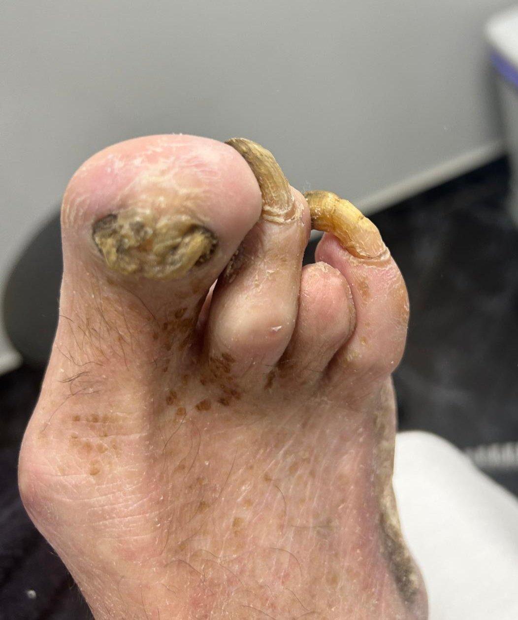 Tratamento podológico 3