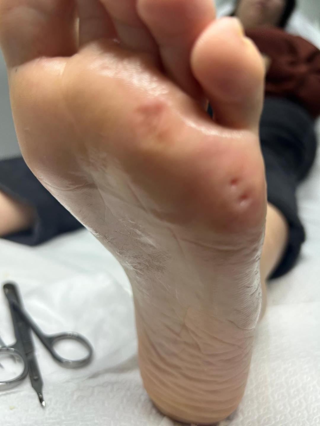 Exemplo de tratamento podológico 6