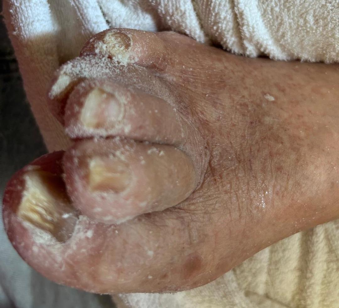 Exemplo de tratamento podológico 4