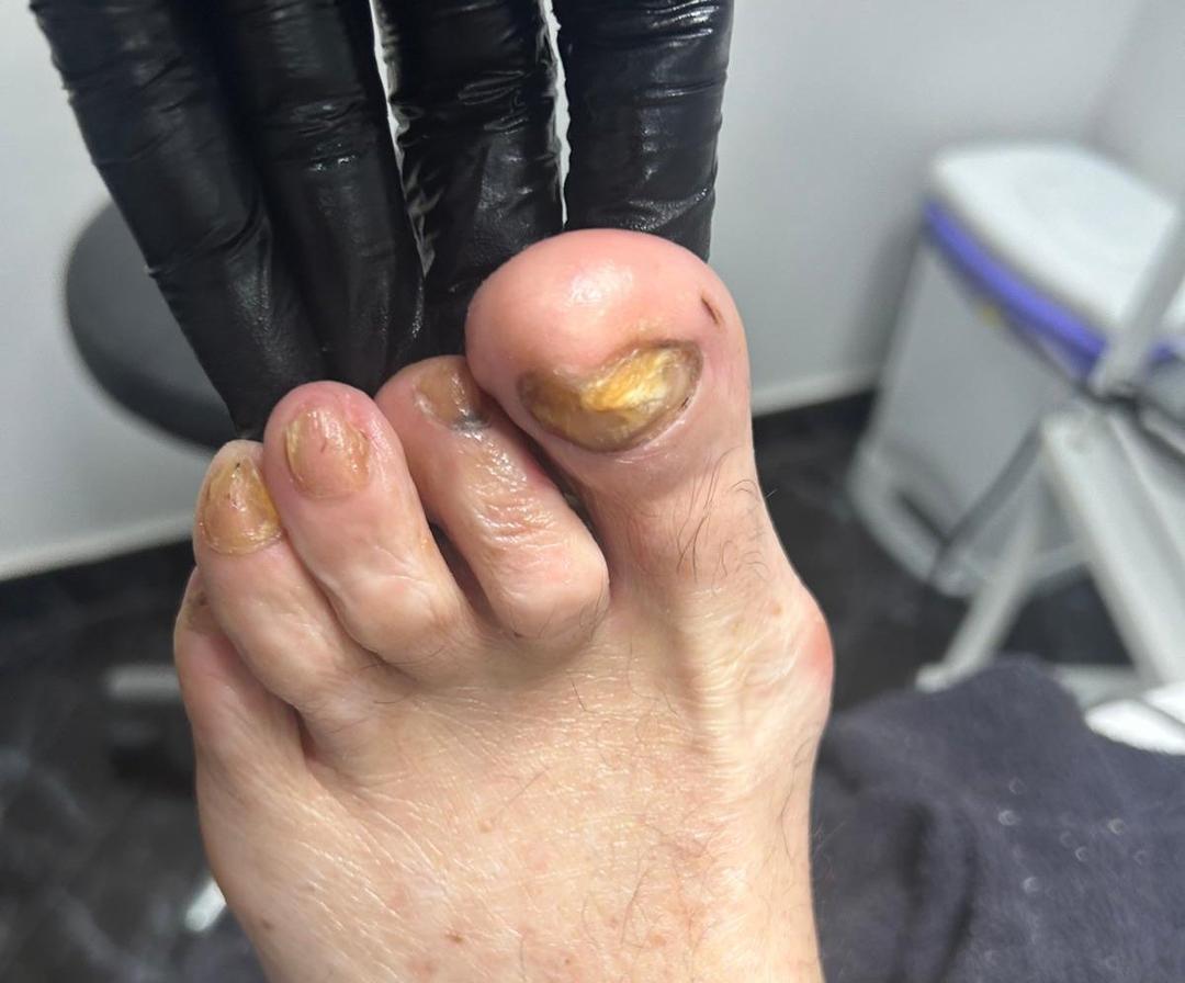 Tratamento podológico 6