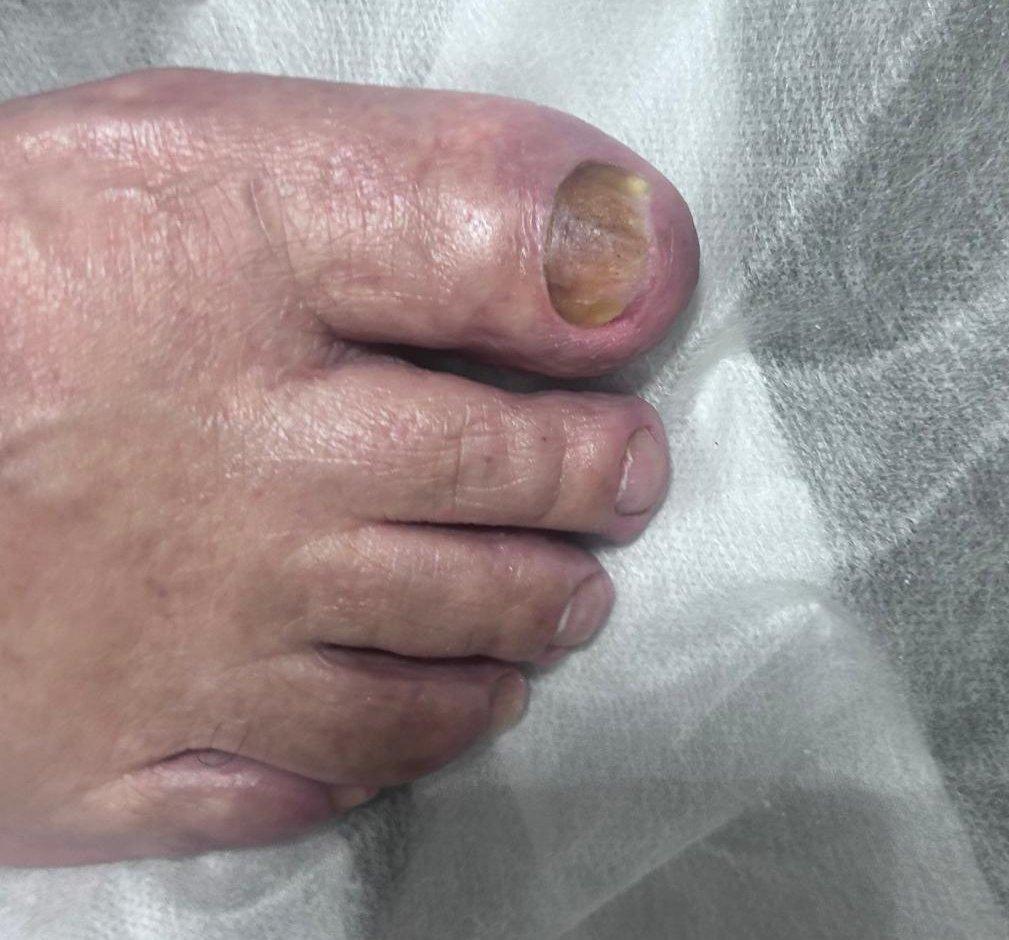 Exemplo de tratamento podológico 1