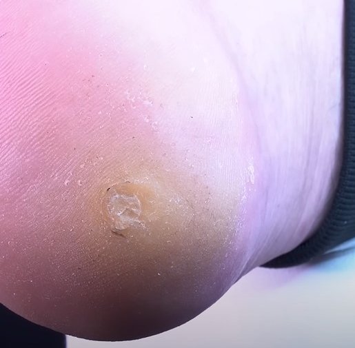 Exemplo de tratamento podológico 2