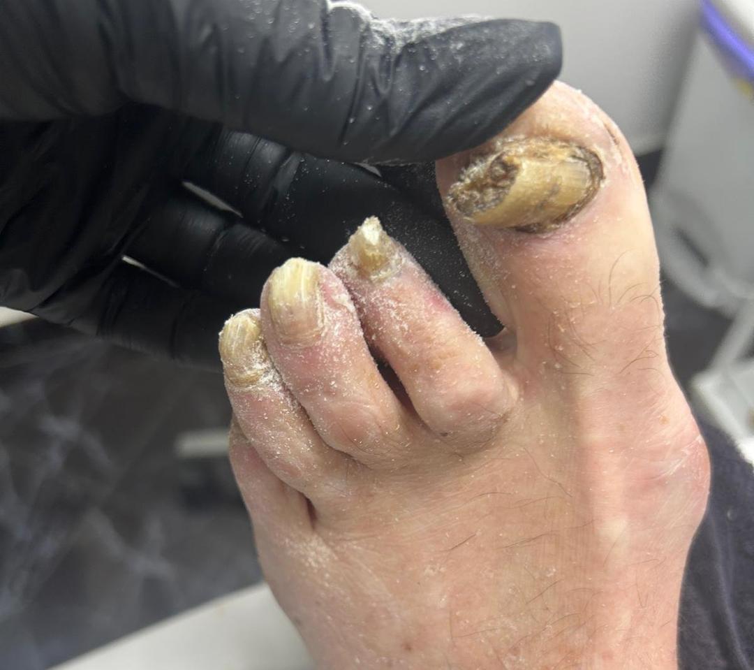 Tratamento podológico 5