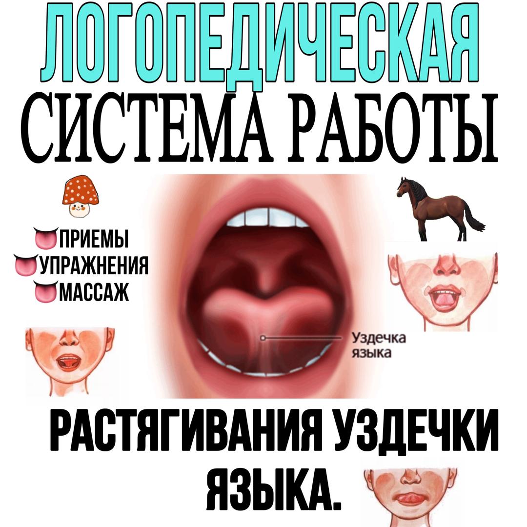 Фото Уздечки Языка Ребенка