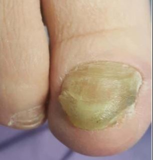 Tratamento podológico 1