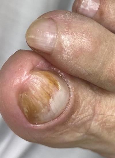 Tratamento de Correção no Corte das Unhas — SOS Calista