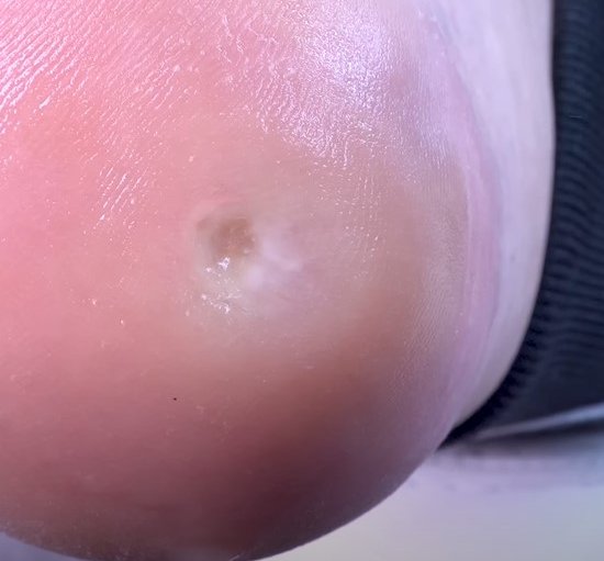 Exemplo de tratamento podológico 3