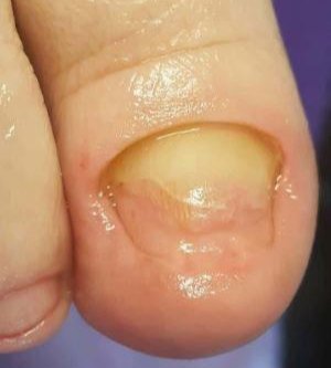 Tratamento podológico 2